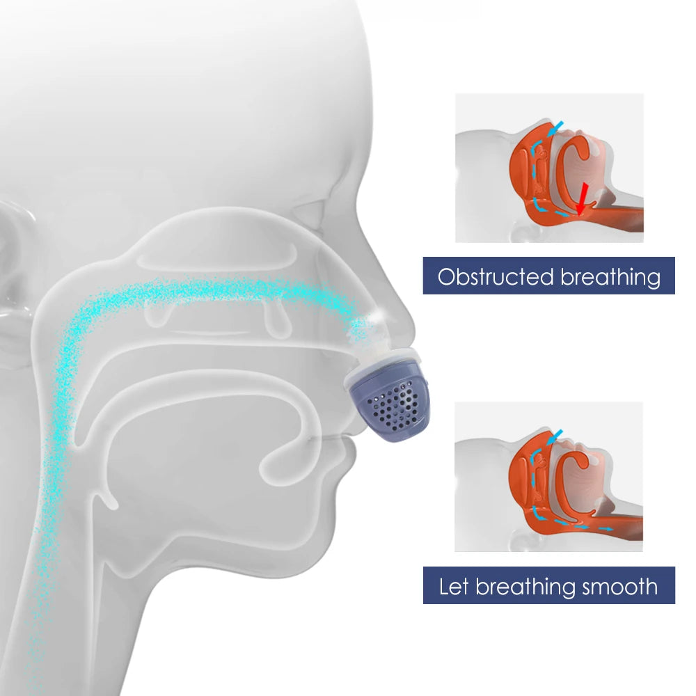 Diagram showing a nasal device and how it helps to smoothen nasal air flow.